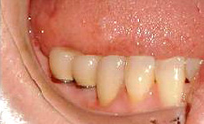 歯を失った際のインプラント治療